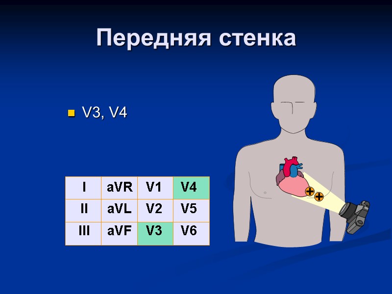 Передняя стенка V3, V4 I II III aVR aVL aVF V1 V2 V3 V4